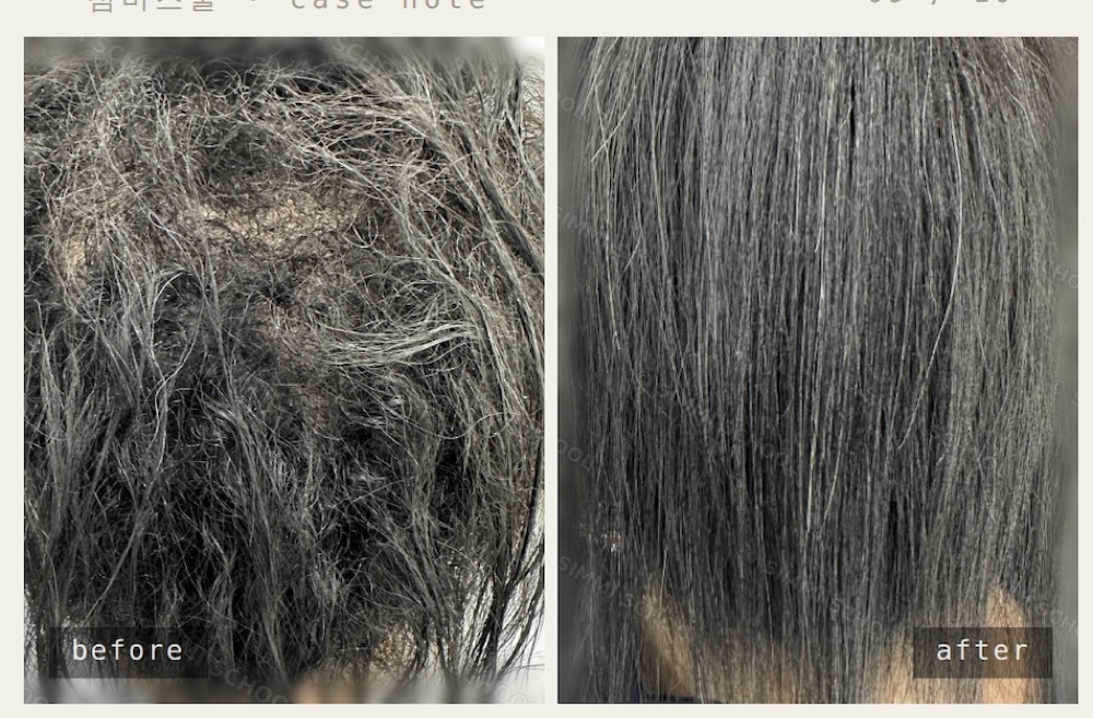 악성곱슬 before after